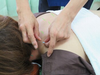 ひまわり鍼灸接骨院の写真/【女性特有の悩みにも】鍼灸施術で身体の内側から改善◎自律神経&ホルモンバランスの乱れに!美容鍼も人気♪