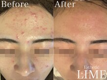 ライム 武庫之荘(LIME)