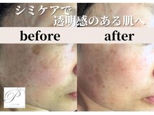 パールホワイトニング/シミケアとララピールで艶肌へ