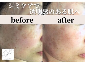 パールホワイトニング/シミケアとララピールで艶肌へ