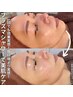 【小顔ケアもしたい方☆】プラズマシャワー＋美容液＋プラズマリフト6500円