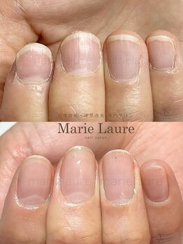 マリーロール 天王寺店(Marie Laure)/自爪育成/深爪矯正/ネイルケア