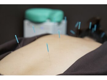 グリーン整骨院/鍼施術風景