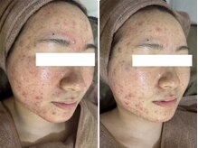 ホワイトアクア 岐阜店(WHITE AQUA)/ハーブピーリング/岐阜/ニキビ