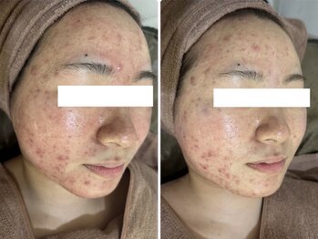 ホワイトアクア 岐阜店(WHITE AQUA)/ハーブピーリング/岐阜/ニキビ