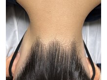 フルールドリス(fleur-de-lis)/うなじ脱毛