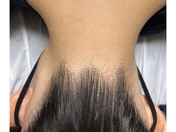 フルールドリス(fleur-de-lis)/うなじ脱毛