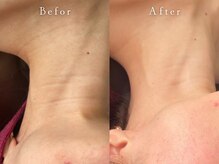 サロン アイプラス(salon i plus)/首のシワ