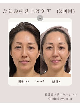クリニカルスイート エーアール(Clinical sweet.ar)/たるみケア×脂肪分解(2回目)