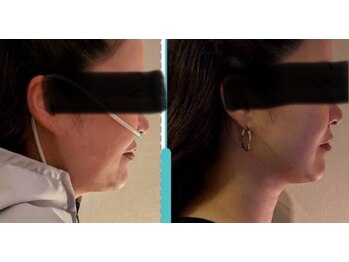 ヨサパーク ハッピーリーズス(YOSA PARK happy risus)/身体だけじゃなく顔までスッキリ