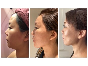 プラチナアース 守谷店(Platinum earth)/小顔矯正でたるみ改善！！