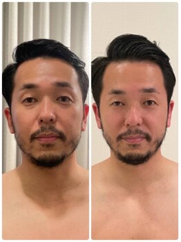 美人バスト 豊橋店/◇小顔症例◇【小顔/豊橋/愛知】