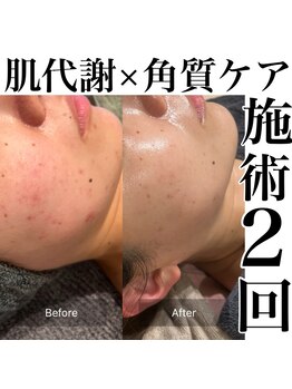 サロンツキ(salon tuki)/ハーブピーリング症例