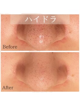 チェリーブロッサム 恵比寿店(CHERRY BLOSSOM)/ハイドラフェイシャル