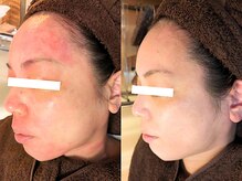 アンシャンテ 神戸元町店(Enchante)/肌質改善フェイシャル神戸元町