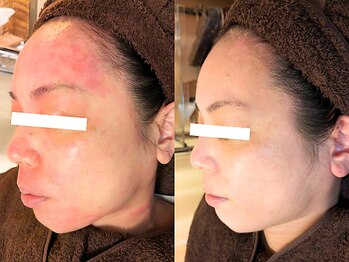 アンシャンテ 神戸元町店(Enchante)/肌質改善フェイシャル神戸元町