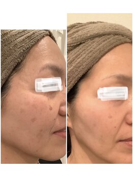 リズ(Liz)/4ヶ月でシミ 肌質 が変わる