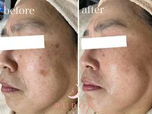 トータルビューティサロン ルボン(RUBON)/RUBONのシミ改善フェイシャル