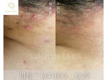 サロンドレナ 名駅店/ハーブピーリング サロンドレナ