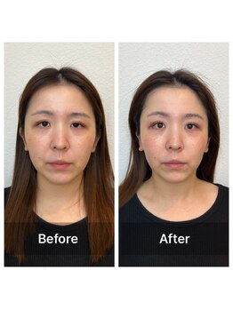 アスト(AST)/小顔矯正/輪郭矯正/リフトアップ