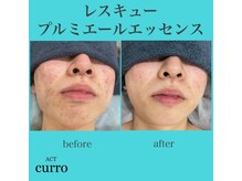 アクト クロ(ACT curro)/レスキューで肌質改善