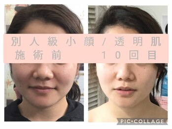 エクラ(Eclat)/小顔+肌質改善+たるみケア専門