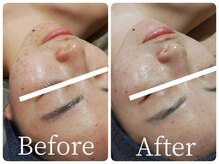 サロン ド ヒノキ(Salon de HINOKI)/大人のニキビケア♪