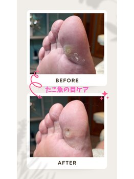 ドクターネイル爪革命 恵庭店/タコ魚の目ケア