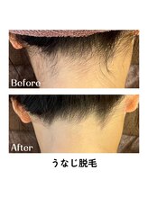 ギルドハナレ(GUILD HANARE)/"美しいうなじ脱毛"