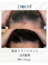 ユミト(Umit)/プロセルスカルプ