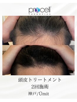 ユミト(Umit)/プロセルスカルプ