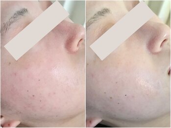 ミュレア 新宿本店(mulea)/【ハイドラフェイシャル】