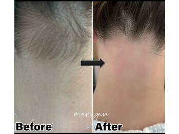 マリヤ(Mariya)/WAX脱毛