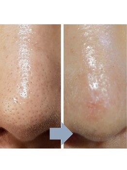 レベンディス(LEVENDIS)/ララピール