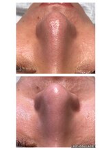 キャピタル(CAPITAL)/ハイドロ毛穴洗浄　フェイシャル