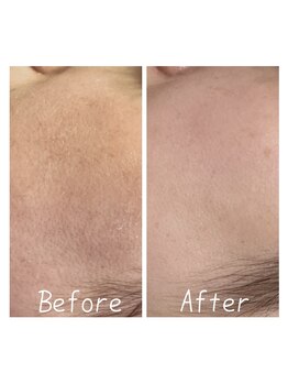 シャルム ココ 八尾店(Charme coco)/ハーブピーリング