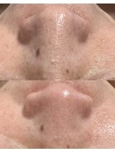 ヨルエステ(yoru aesthe)/【全顔毛穴洗浄】