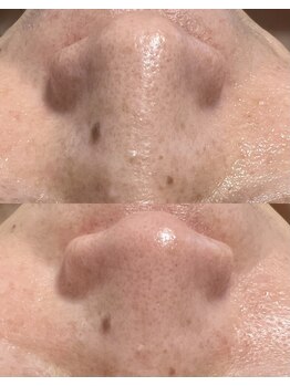 ヨルエステ(yoru aesthe)/【全顔毛穴洗浄】