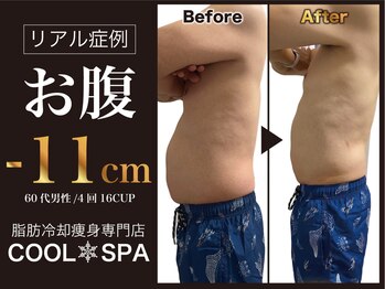 クールスパ(COOL SPA)の写真/男性歓迎！中年太りのお腹に脂肪冷却でスッキリ
