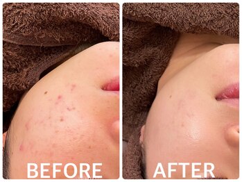 ハーブピーリング 恵比寿/ニキビ改善/肌管理/肌質改善