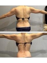 ラヴィエール(Laviere)/レディース痩身120分4回目