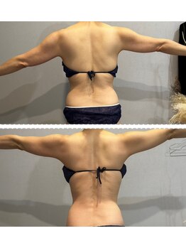 ラヴィエール(Laviere)/レディース痩身120分4回目