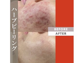 バーグトータルビューティー(bague total beauty)/ダウンタイム無ハーブピーリング