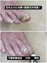 巻き爪じゅん 千葉駅前店/石のように分厚い肥厚爪が改善