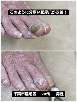 巻き爪じゅん 千葉駅前店/石のように分厚い肥厚爪が改善