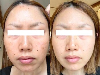 アンシャンテ 神戸元町店(Enchante)/毛穴洗浄ピーリングフェイシャル