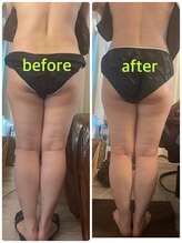 サニー(SUNNY)/痩身キャビテーション３部位