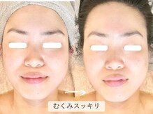 こもれび/１回のお手入れでの変化