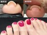 【FOOTジェル】巻き爪専用ジェル+ジェルワンカラー¥13200→¥11000