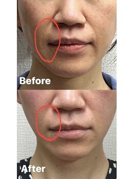 きらり 天神店/小顔施術でほうれい線ケア♪